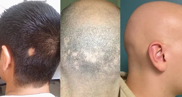 Alopecia, domenica 16 settembre consulti e punti informativi curati dal reparto di Dermatologia