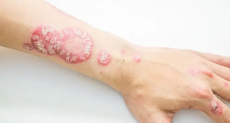 Malattie rare, psoriasi pustolosa generalizzata per 150 italiani: al via campagna