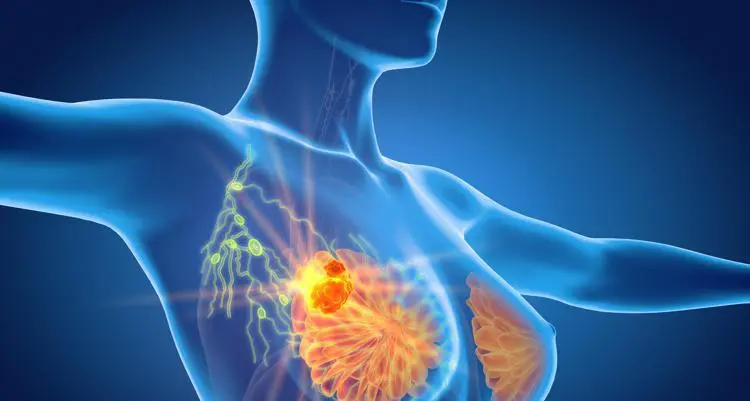 Cancro seno in stadio precoce, farmaco riduce del 32% rischio recidiva a 5 anni