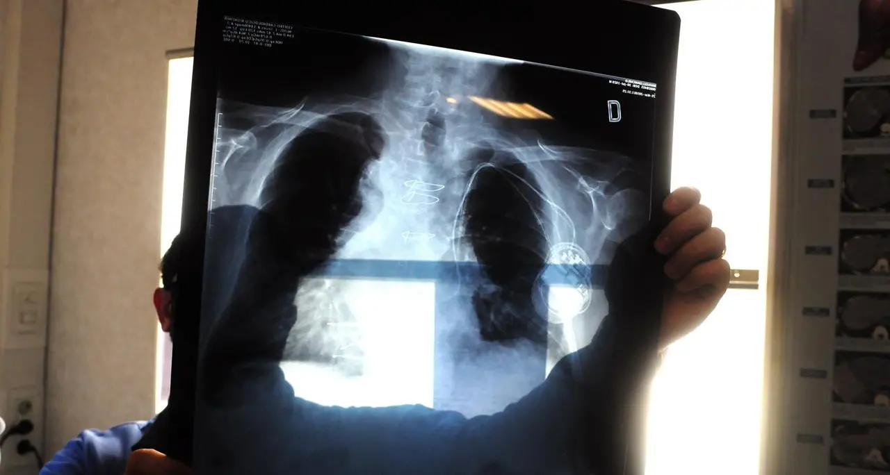 Tumori, in Italia 395mila casi nel 2023, ondata diagnosi post pandemia e -3% screening
