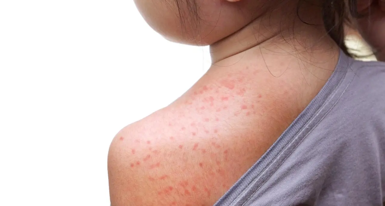 Boom morbillo e pertosse, l'esperto: \"Rischiano gli adulti\"