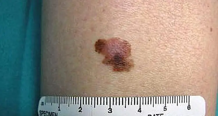 Melanoma, boom nei giovani: è il cancro più comune negli under 30