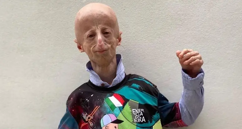 Muore a 28 anni Sammy Basso, il più anziano malato di Progeria