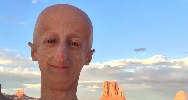 Progeria, cos'è la malattia di cui soffriva Sammy Basso