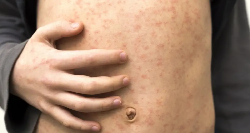 Morbillo, casi in aumento: “Trend molto preoccupante”