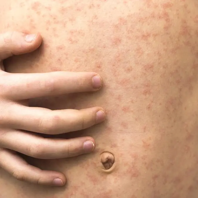 Un italiano su 10 a rischio: allarme tra i giovani adulti per il morbillo