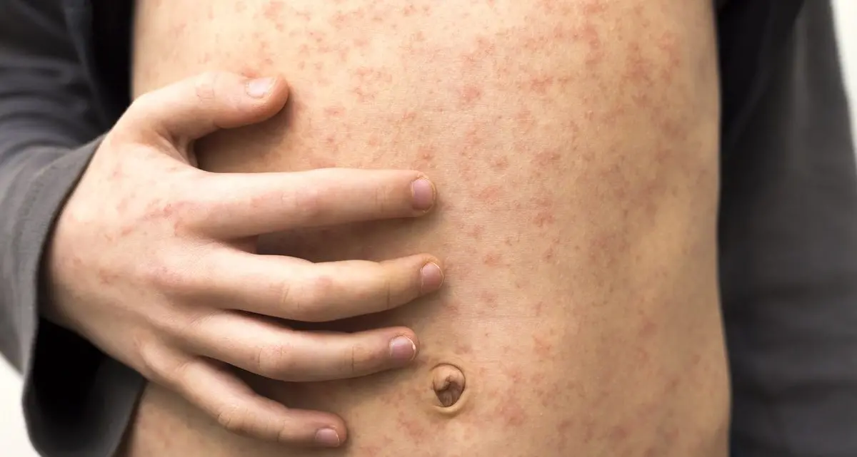 Un italiano su 10 a rischio: allarme tra i giovani adulti per il morbillo